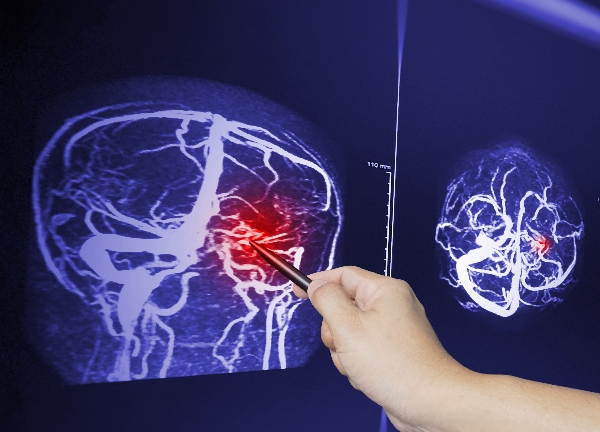Hand pointing to MRI image of traumatic brain injury